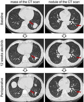 Pathological complete response to long-course neoadjuvant alectinib in lung adenocarcinoma with EML4-ALK rearrangement: report of two cases and systematic review of case reports
